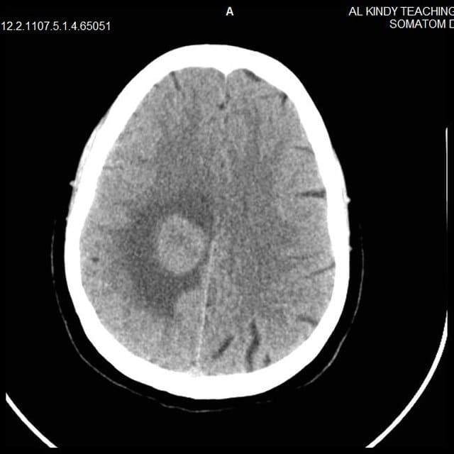 Опухоль головного мозга на КТ снимке